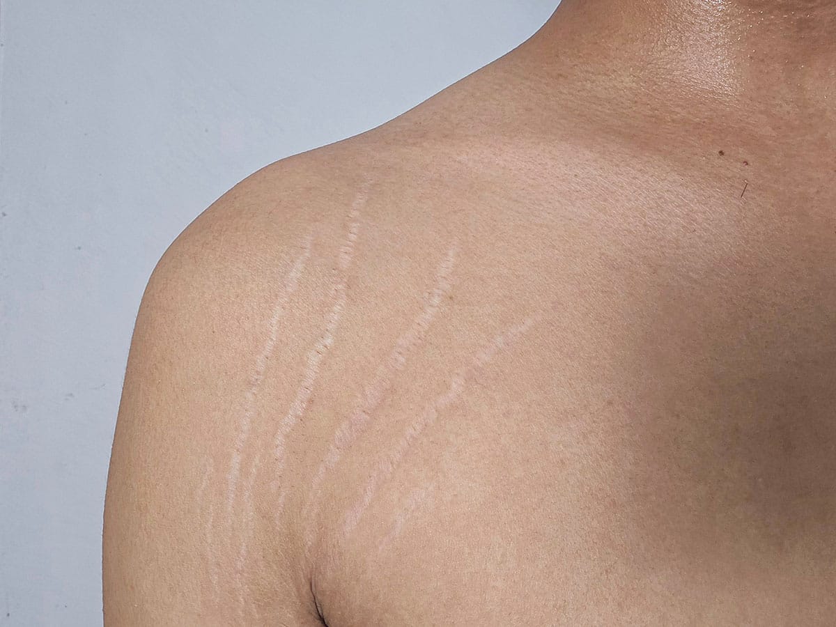 Stretch marks on a man’s armpit.  