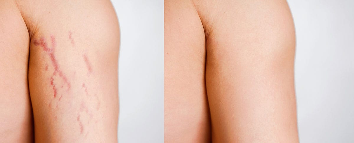 Before and after of bicep stretch marks with treatment