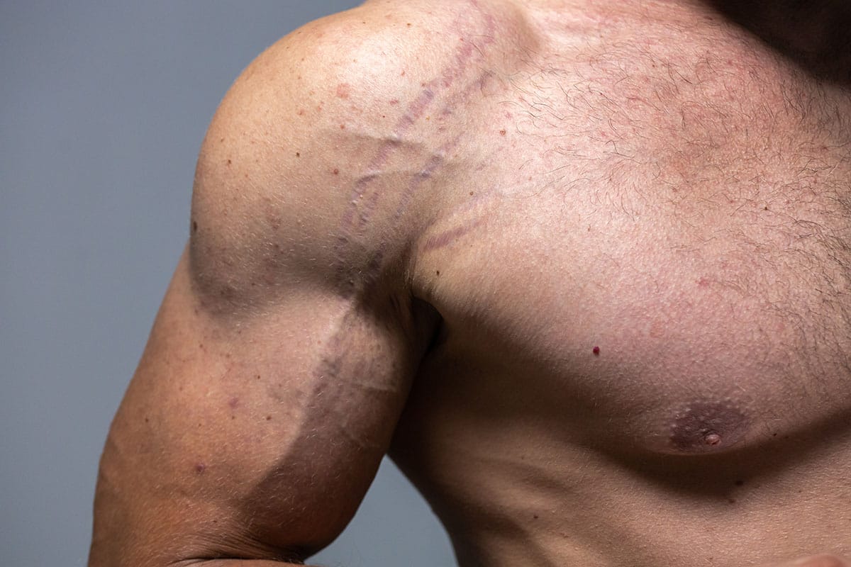 Man with muscular arm with stretch marks